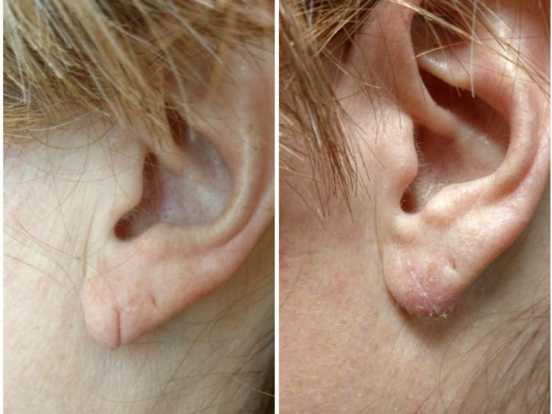 Ear Lobe Repair 1 Ear Lobe Repair 1