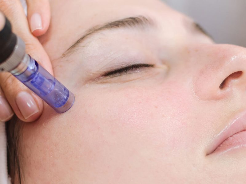 Microneedling