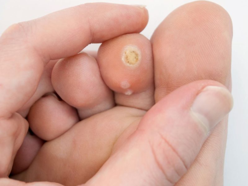 Wart- Corn Removal Wart- Corn Removal